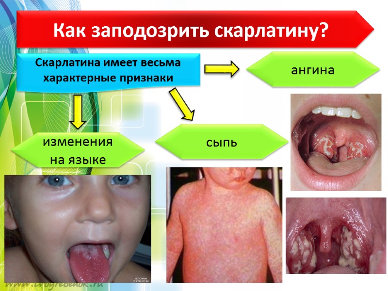 Как заподозрить скарлатину? Скарлатина имеет весьма характерные признаки ангина сыпь изменения на языке